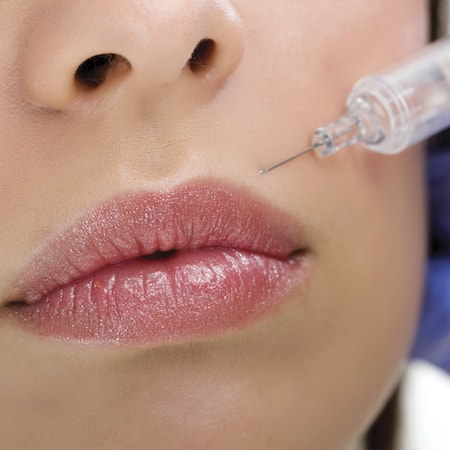 Botox being injected into a patients upper lip area