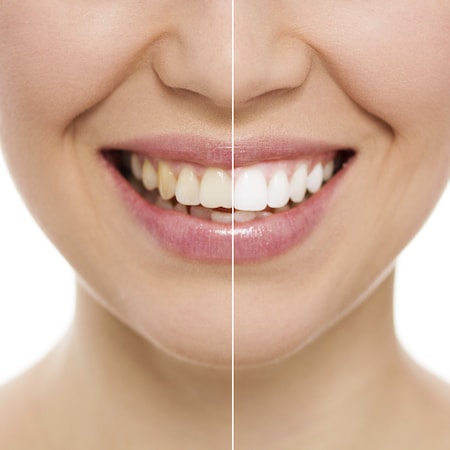 Split image to show the before and after of teeth whitening