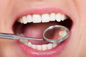 Close-up of a person's mouth with healthy white teeth, as a dental mirror is used to examine oral health during a dental check-up.