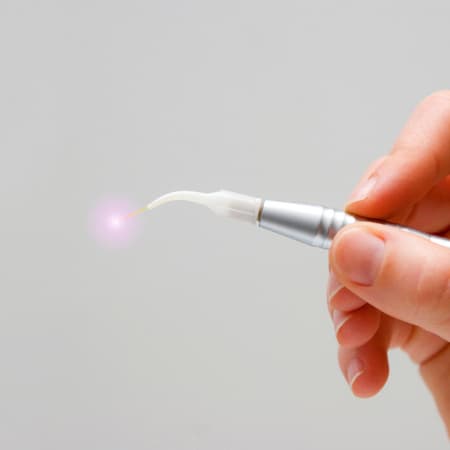 A hand holding the LANAP® laser