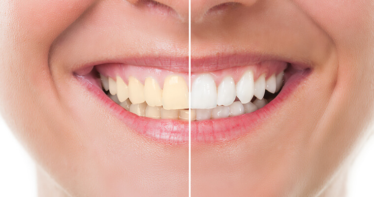 Before and After closeup of professional teeth whitening
