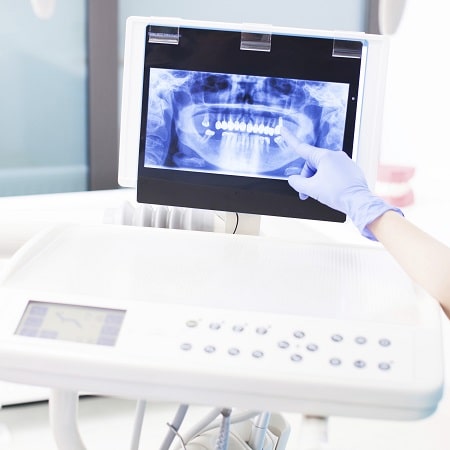 Digital dental x-ray displayed on a monitor with a gloved hand pointing, showcasing advanced imaging technology for accurate diagnosis and treatment planning.