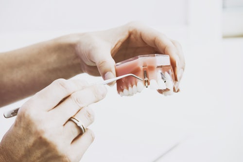 Diagram of the three parts of a dental implant - post, abutment, and crown