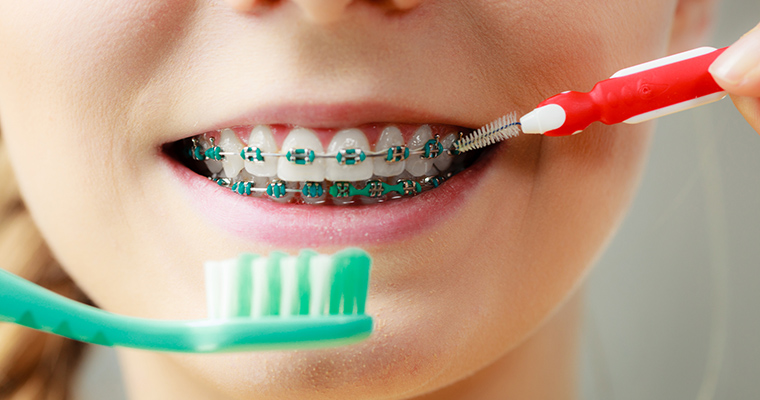 How to Maintain Oral Hygiene with Braces