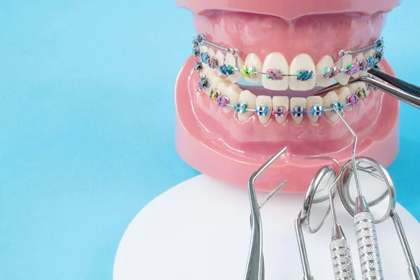 What Causes Braces’ Brackets to Fall Off?