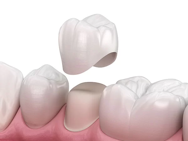 3D illustration of a dental crown being placed on a tooth, representing dental restoration services for emergencies like lost crowns or fillings.