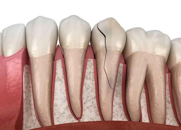 Illustration of a cracked tooth highlighting dental anatomy, relevant to emergency dental care for cracked or fractured teeth.