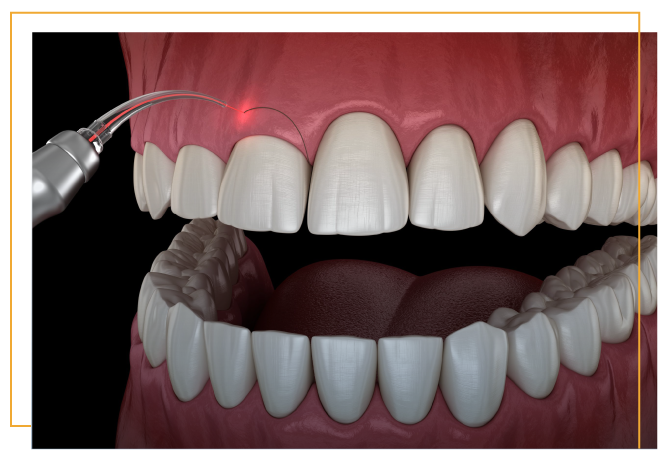 LANAP treatment